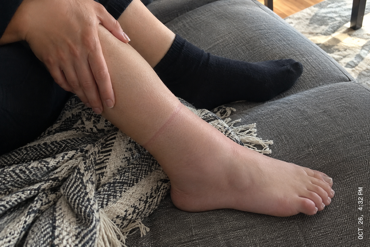 A puffy ankle resting on a sofa at the end of the day.